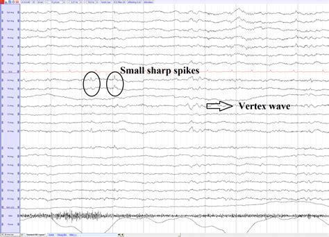bets eeg